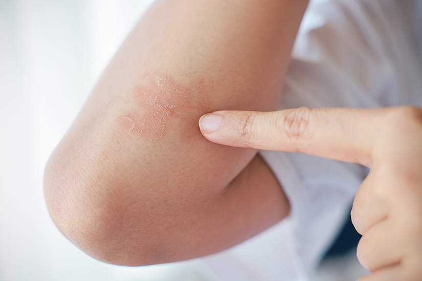 Psoriazis