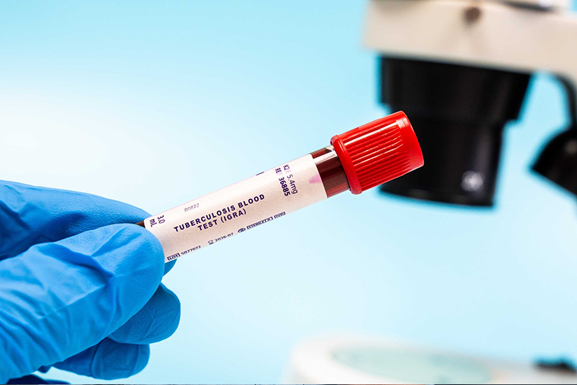 Analiză de laborator pentru diagnosticarea tuberculozei