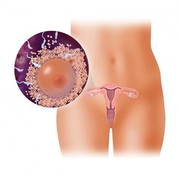 Cu condiloame puteți rămâne gravidă - Infectia cu HPV iti afecteaza sau nu fertilitatea?