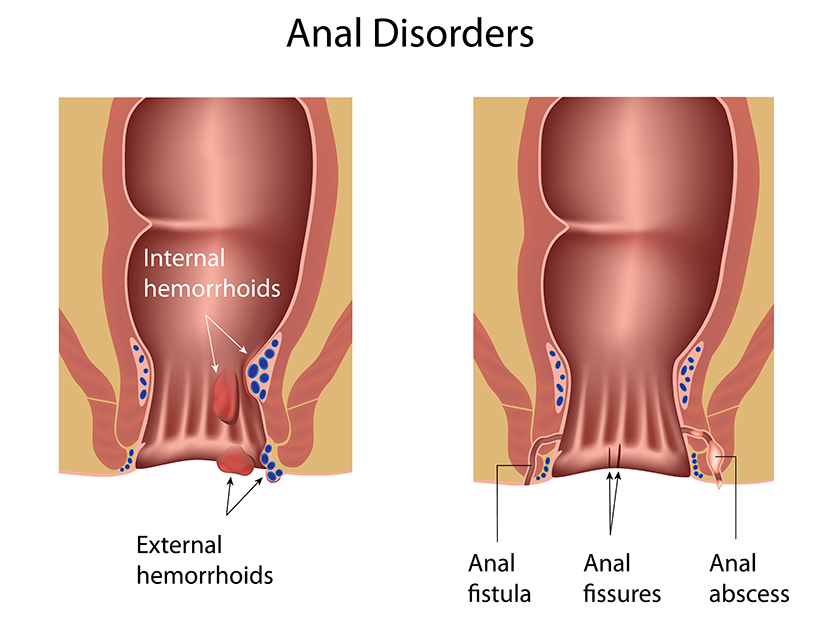 Abcesul anal si fistula anala