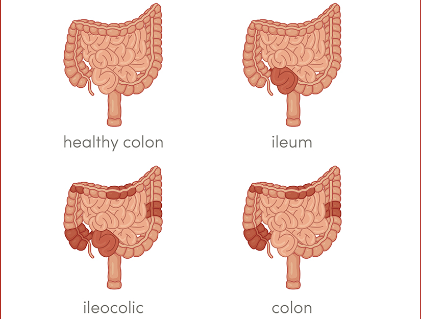 Simptomele bolii Crohn