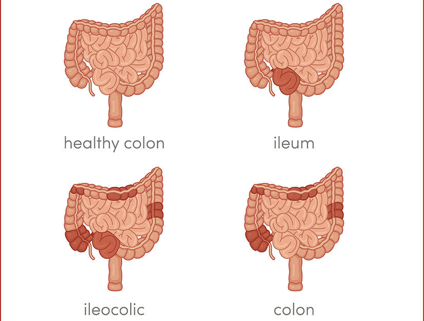 pierderea în greutate boala crohn)