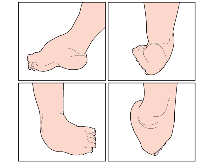 boli ale articulațiilor mici ale piciorului)