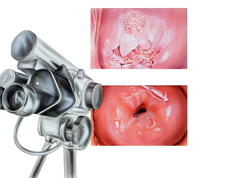 Colposcopia – componenta importanta in diagnosticul leziunilor precanceroase ale colului uterin