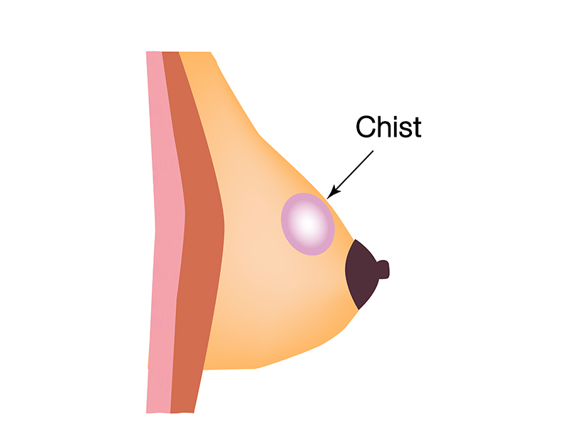 Chisturile De San Manifestari Clinice Diagnostic Si Tratament