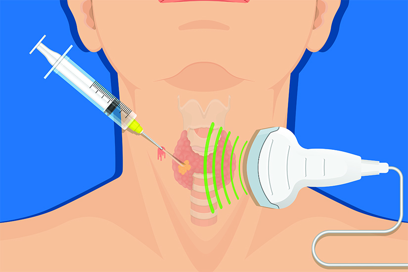 Importanta punctiei-aspiratie pe ac fin (FNA) in managementul nodulilor tiroidieni