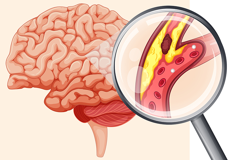 Ecografia carotidiana poate fi folosita pentru prevenirea accidentului vascular cerebral? 