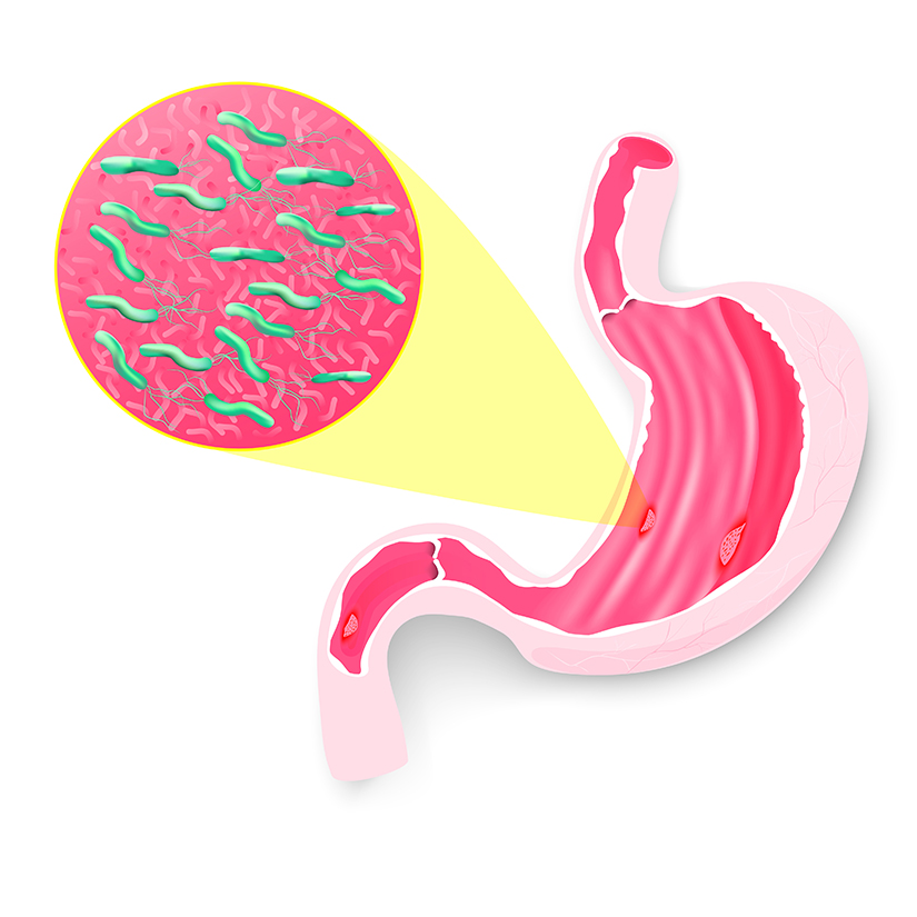 Testul respirator pentru detectarea infectiei cu Helicobacter pylori