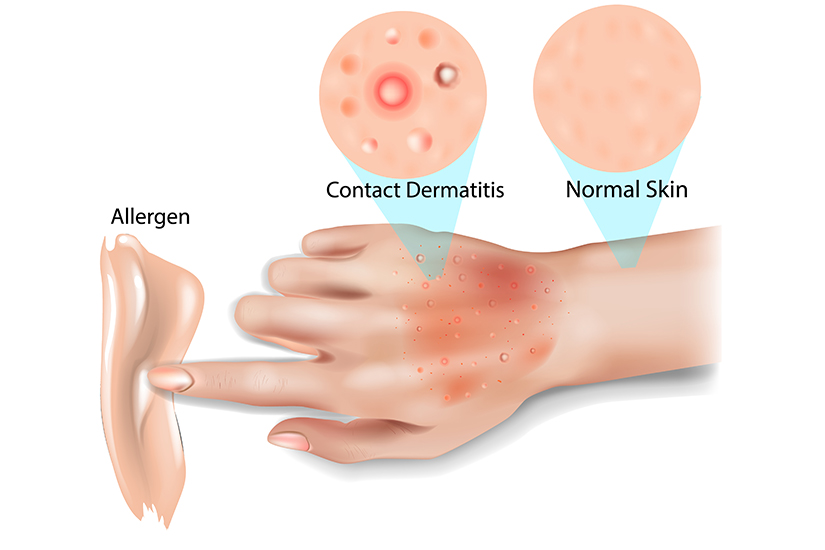 Boli comune de piele: dermatita de contact