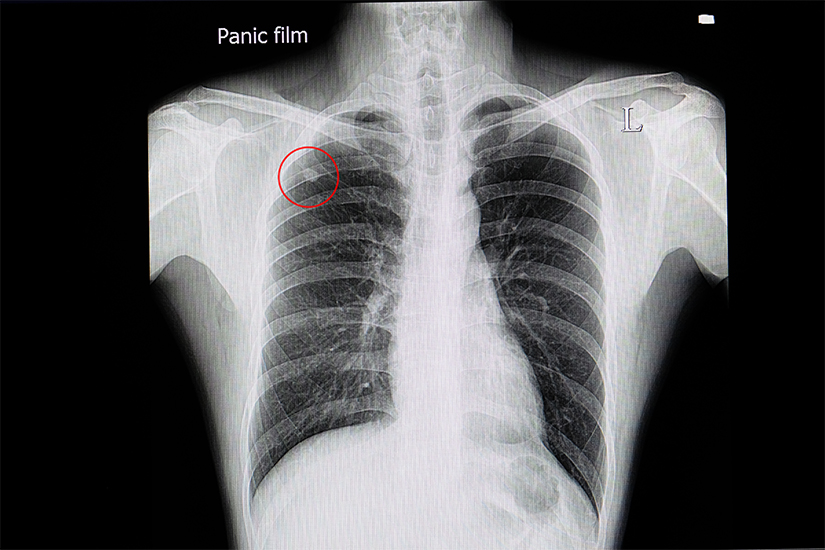 Radiografie plamani cu imagini
