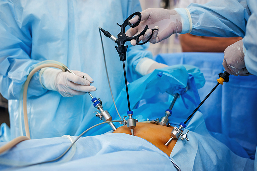 Este posibilă laparoscopia pentru varice?