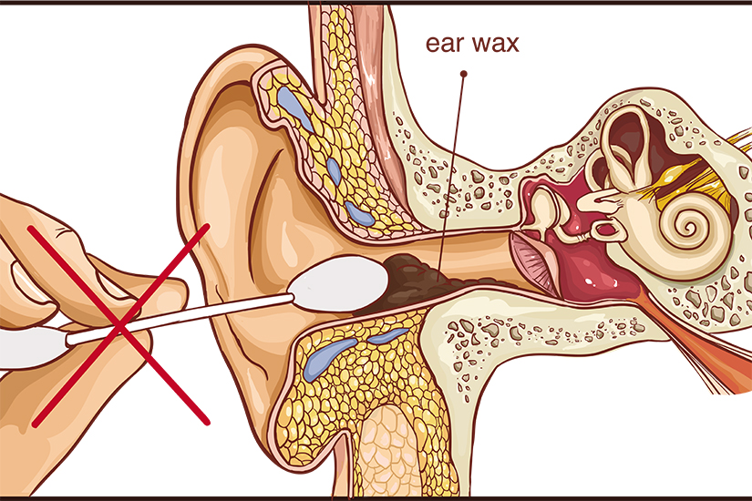 Otalgia - Alerta ORL