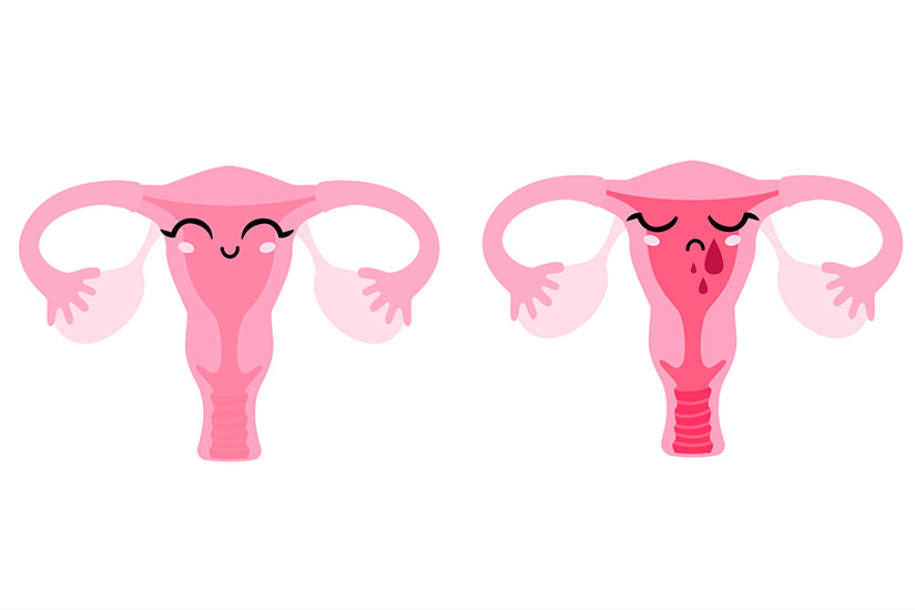 Tot ce trebuie sa stii despre sindromul premenstrual si cum il tratezi