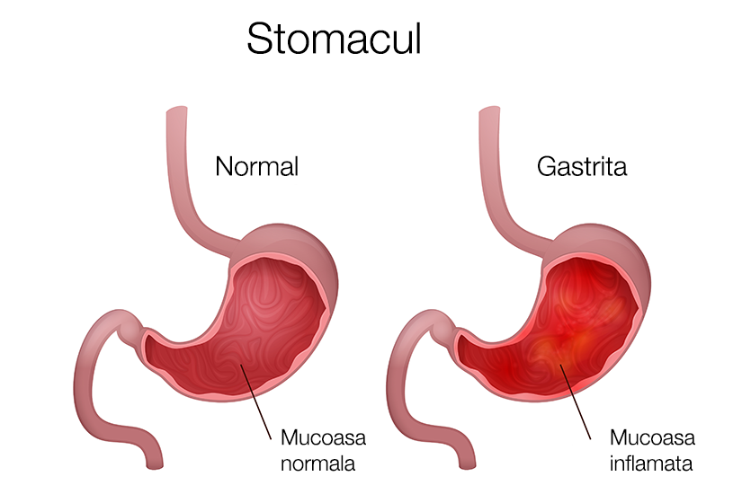 Gastrita Cronică Simptome Diagnostic Tratament Actualitate