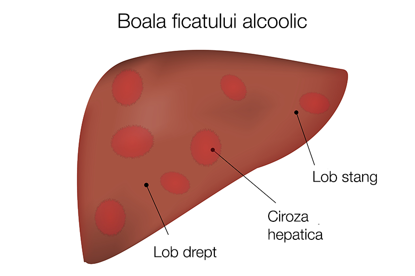 Boala ficatului alcoolic | Reginamaria.ro