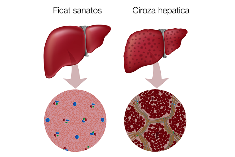 boala hepatică și varicoză