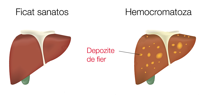 Hemocromatoza