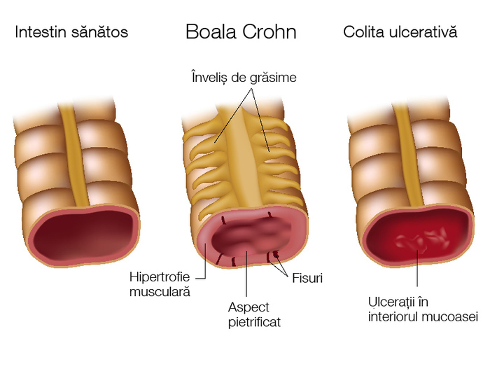 Simptomele bolii Crohn