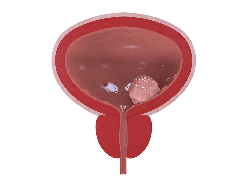 Cancerul de vezica urinara - Cistectomia da Vinci - Chirurgia da Vinci