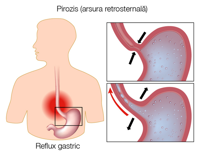Arsura retrosternala (pirozis) vs. infarct de miocard