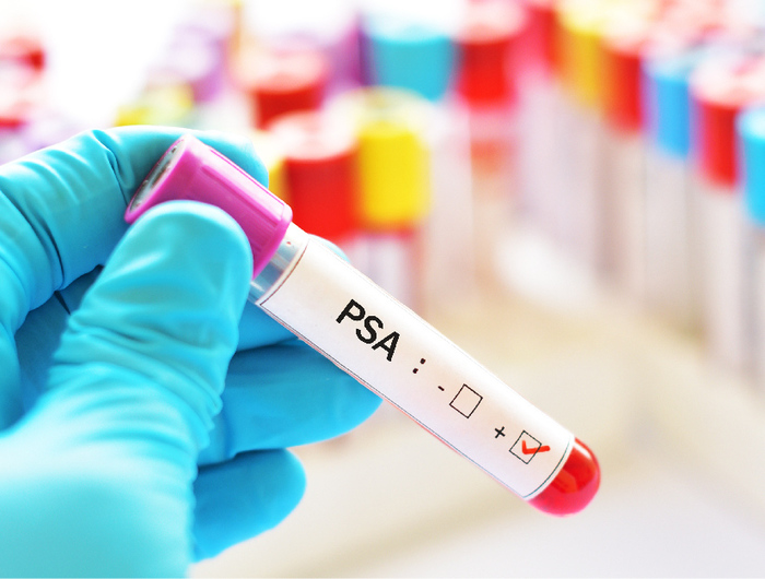 PSA (Antigen specific prostatic)