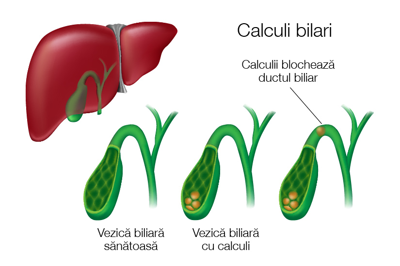 Calculii biliari: tot ce trebuie sa stii