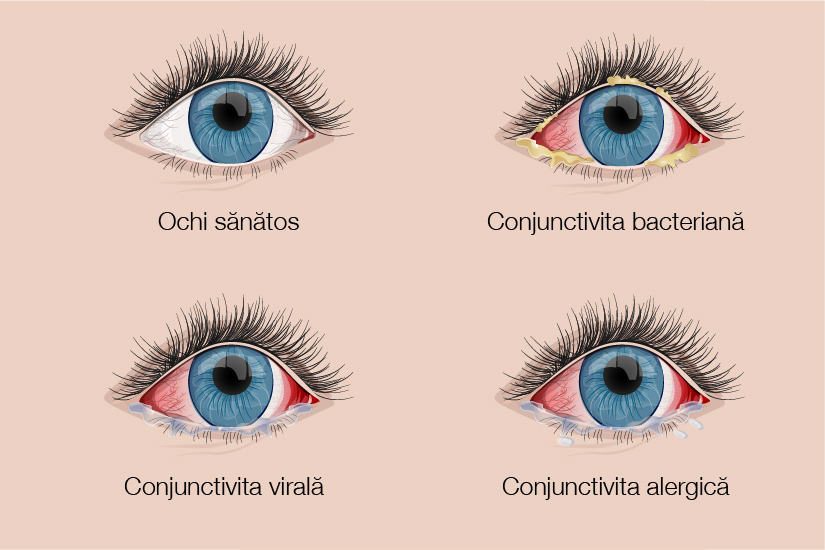 Diplopia sau vederea dubla - cauze, simptome si tratament