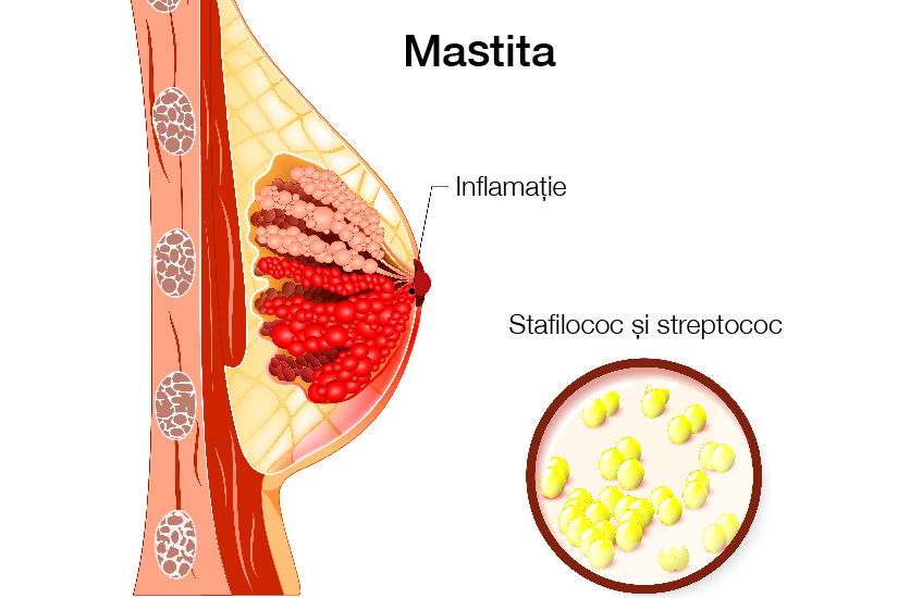 Simptome de inflamație la nivelul șoldului