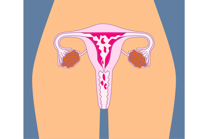 menstruație abundentă din cauza varicelor