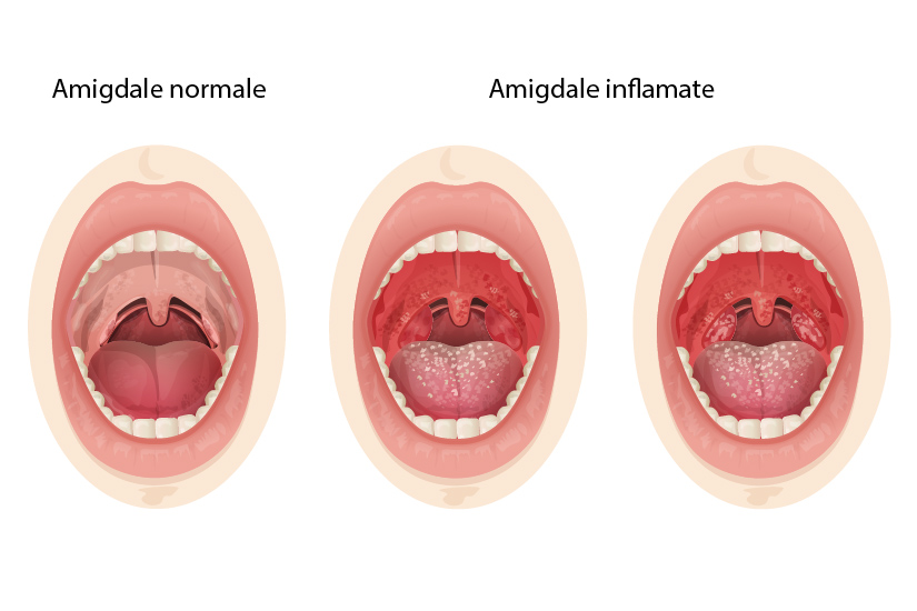 dureri articulare amigdalelor