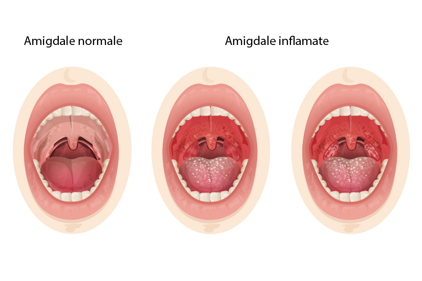 dureri articulare amigdalite)