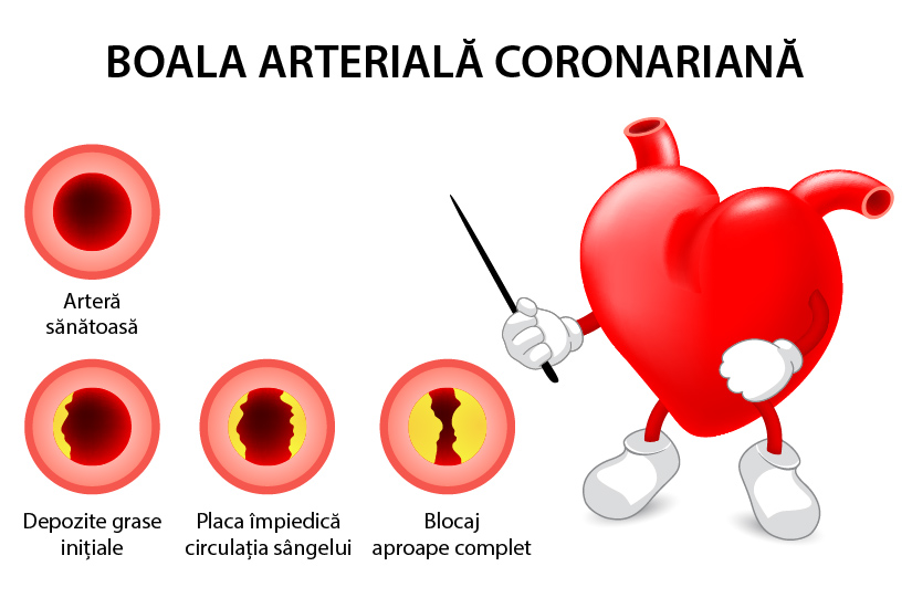 Boala arteriala coronariana (cardiopatia ischemica)