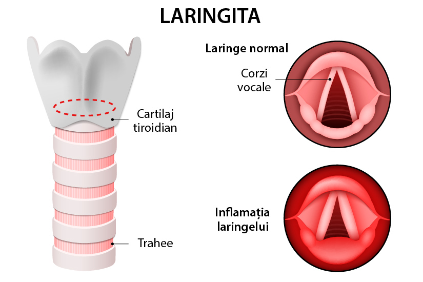Chondroperichondrita - inflamația laringelui