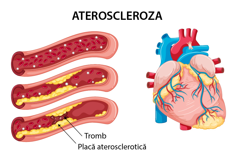 Arterioscleroza si ateroscleroza: simptome, cauze, complicatii, diagnostic si tratament