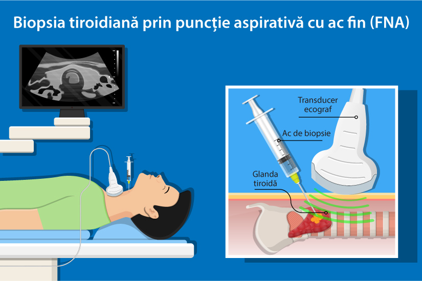 Biopsia de tiroida: 10 intrebari si raspunsuri | Reginamaria.ro