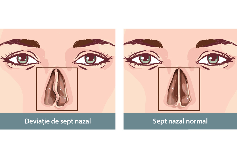 inflamația cartilajului a nasului)