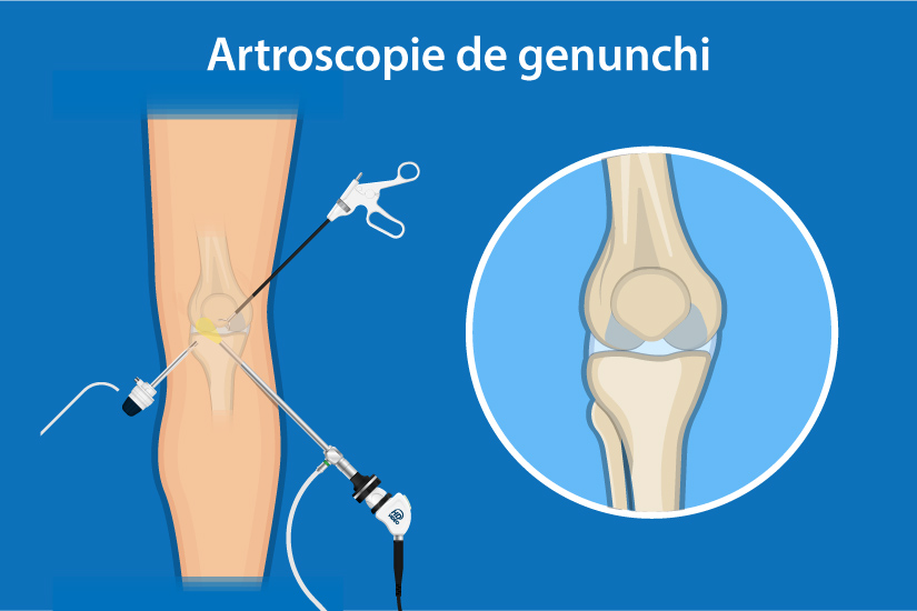 tratament artroscopic al articulației genunchiului