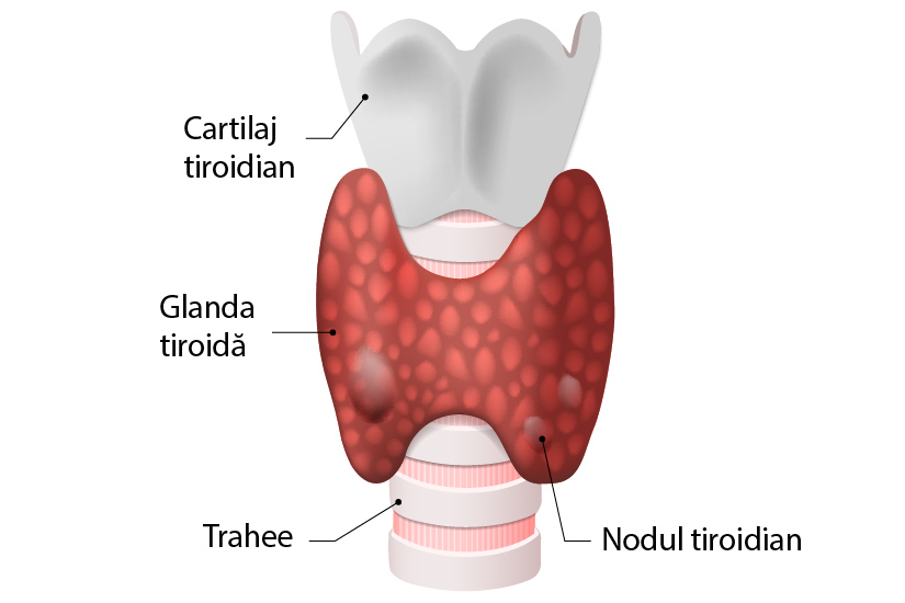 Evaluarea prin elastografie ultrasonica a nodulilor tiroidieni