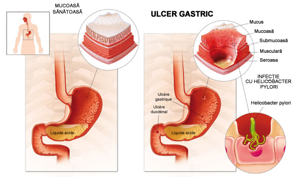 Ulcer gastric și scădere în greutate