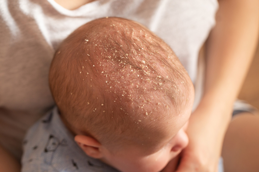 Dermatita seboreica bebe
