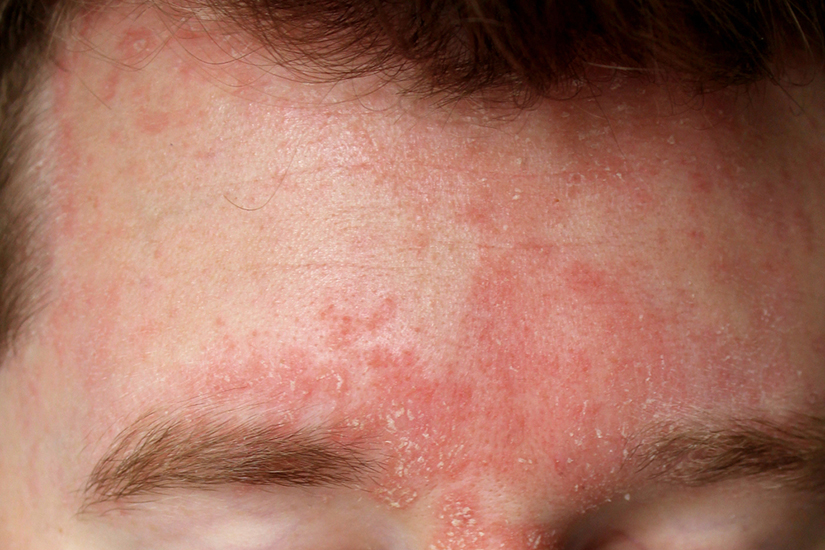 Ce este dermatita seboreică și cum poate fi tratată?