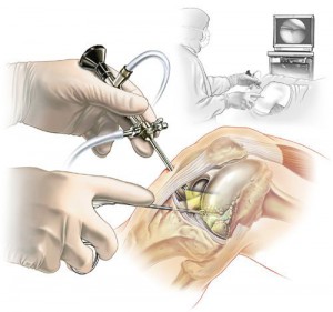 VIDEO Operatia de reconstructie a ligamentului incrucisat anterior