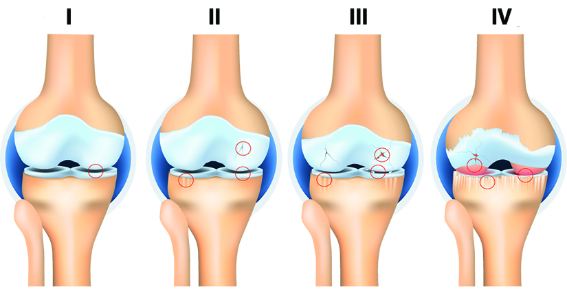 artroza articulațiilor genunchiului 1 grad)