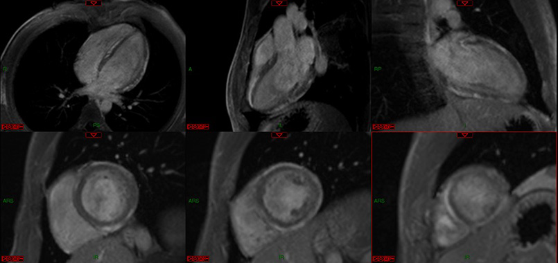 IRm cardiac