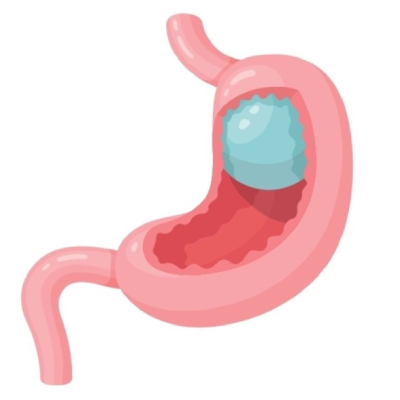 balon_gastric