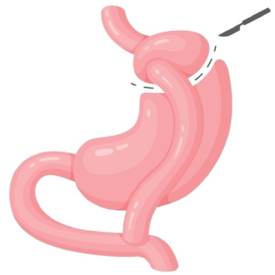 gastric_bypass