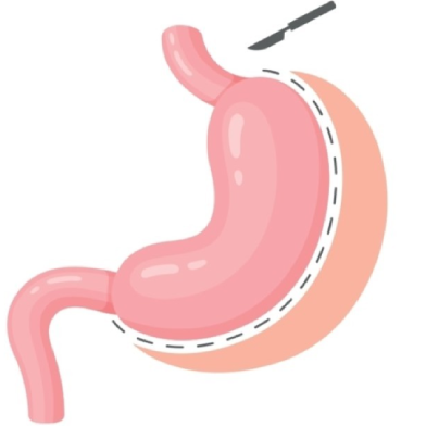 gastric_sleeve