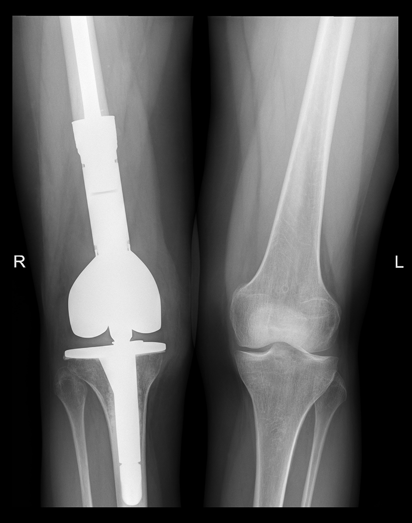Reconstructie cu proteza modulara de genunchi
