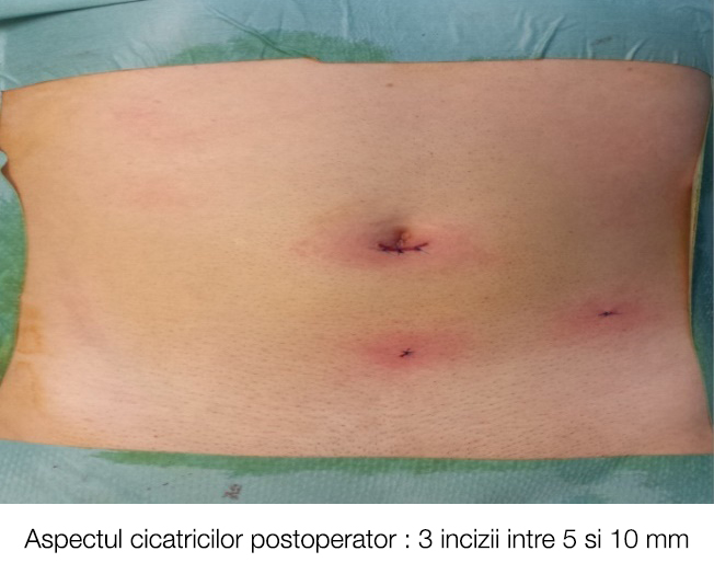 Aspect pos-toperator hernii