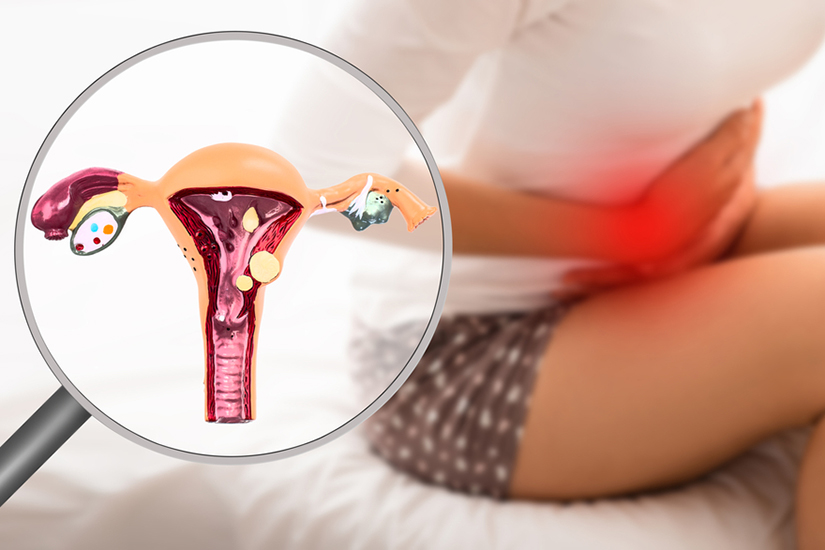 tratamentul de endometrioza varicoza